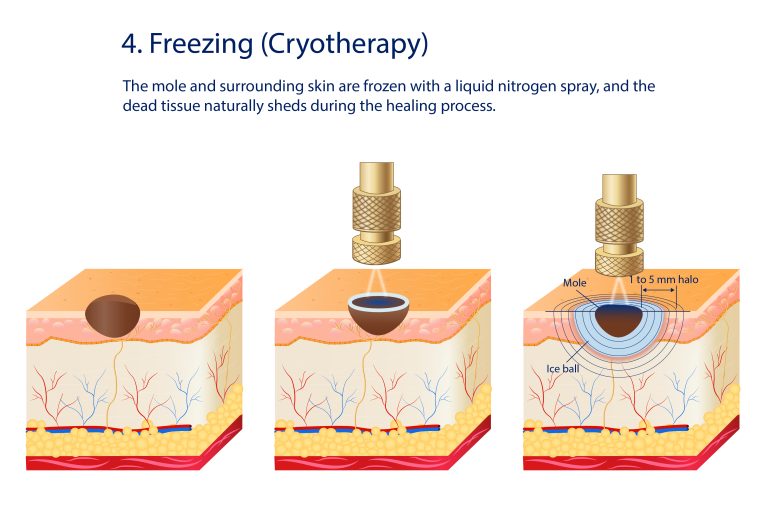 cryotherapy for mole removal