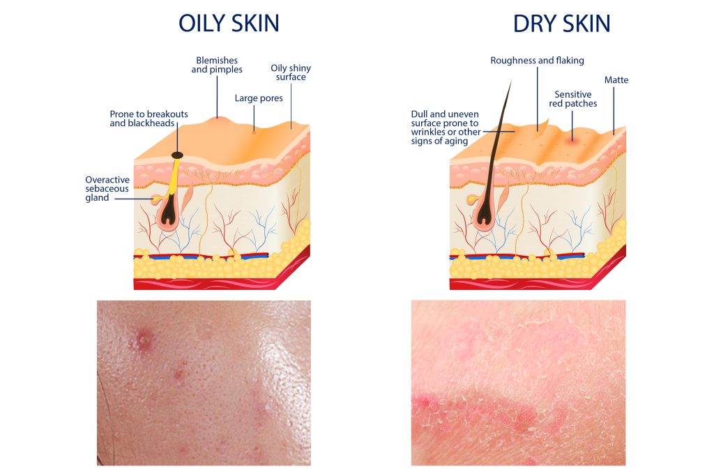 Oily Skin vs Dry Skin