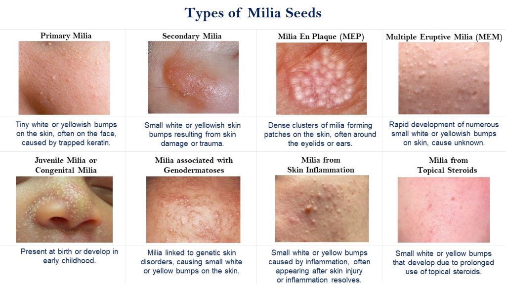 image showing types of milia seeds