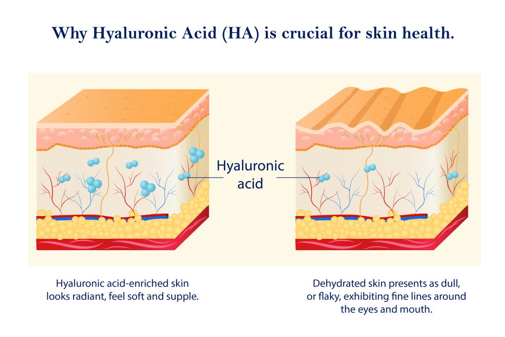 Hyaluronic Acid under the skin