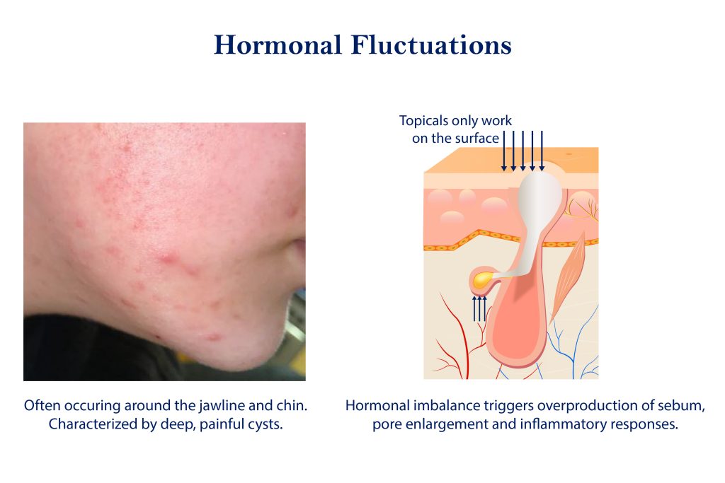 Hormonal Fluctuations