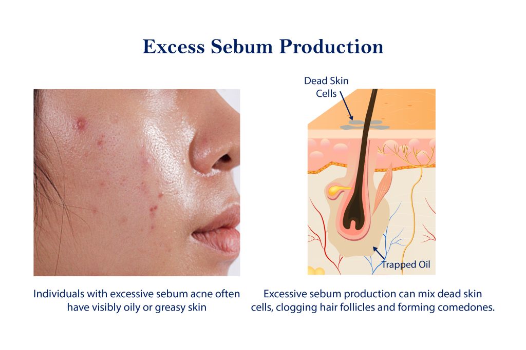 Excess Sebum Production