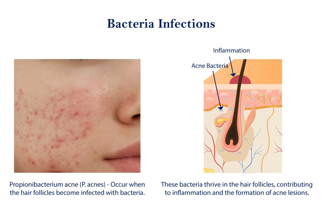 Acne Bacteria Infections