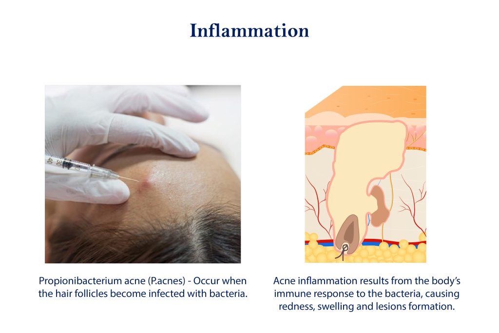 Acne Inflammation