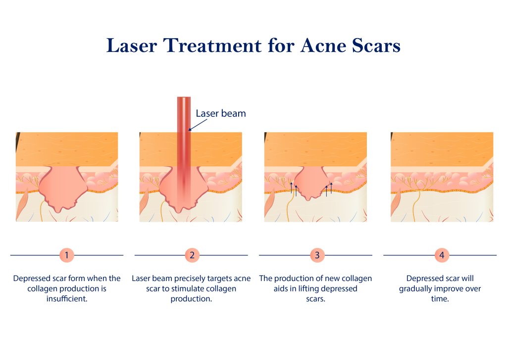 Lase treatment for acne scars