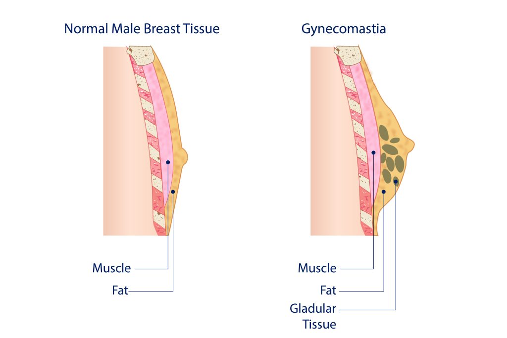 Illustration of difference between Gynecomastia and normal male breast tissue