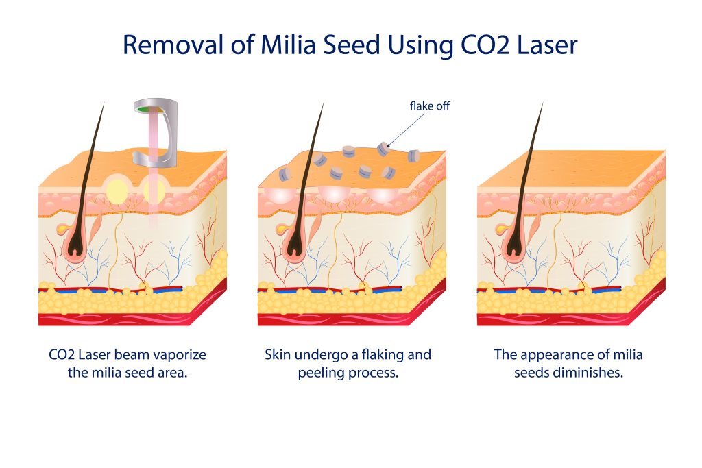 diagram explaining removal of milia seeds using CO2 laser treatment