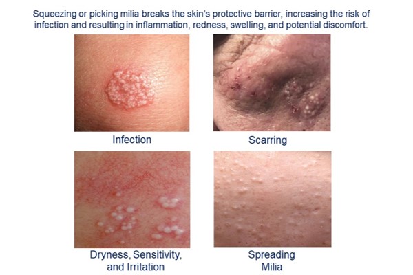 image showing various irritations caused by milia seeds