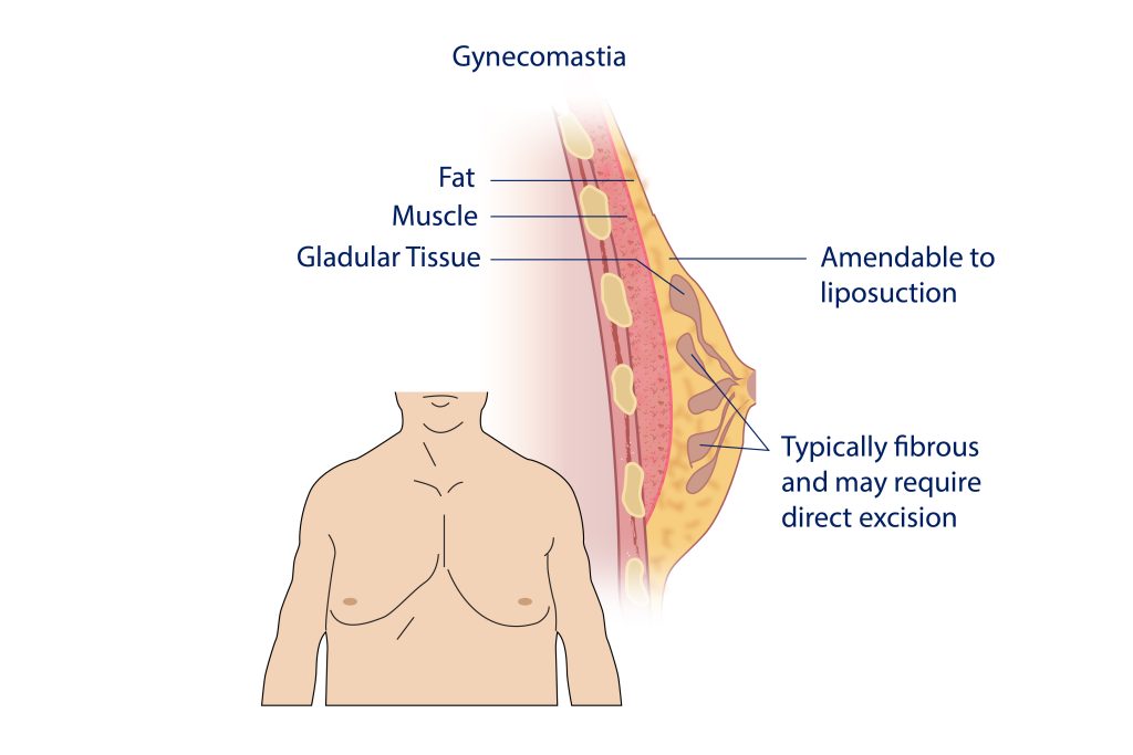 Illustration with labeled diagram of gynecomastia condition 