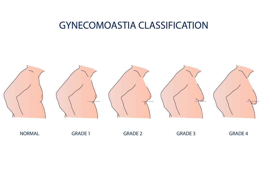 Illustration showing different stages of gynecomastia