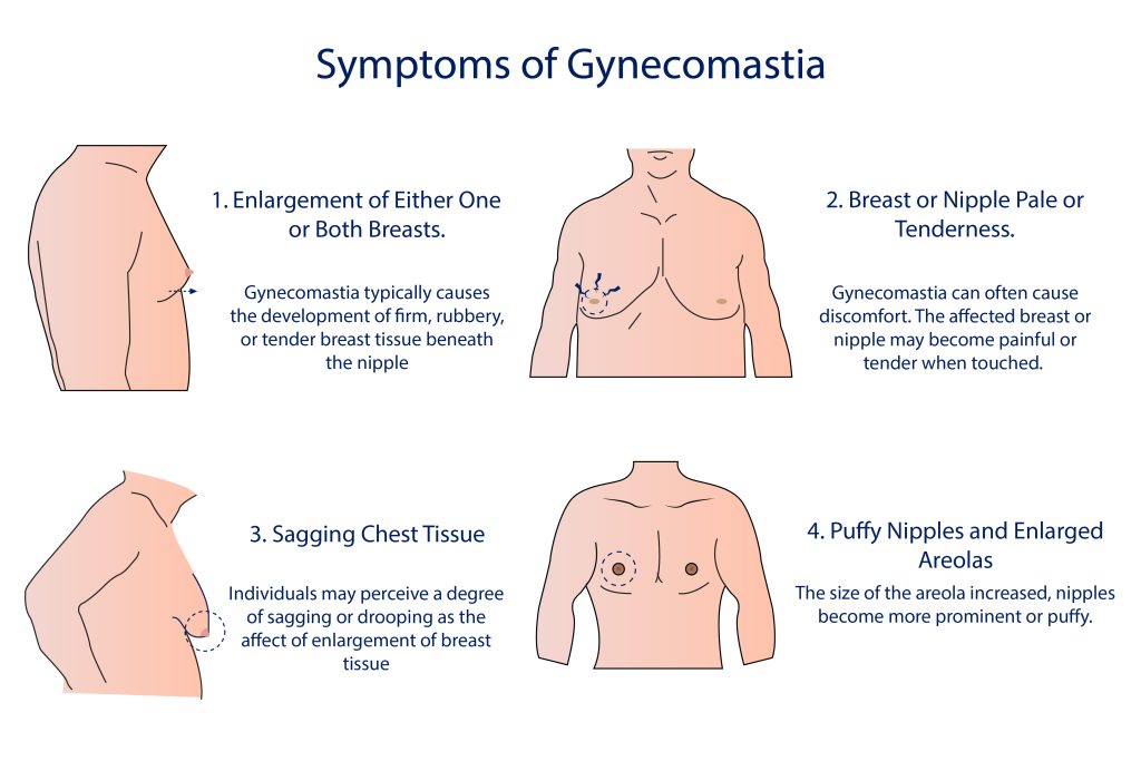Illustration showing symptoms of gynecomastia in four stages