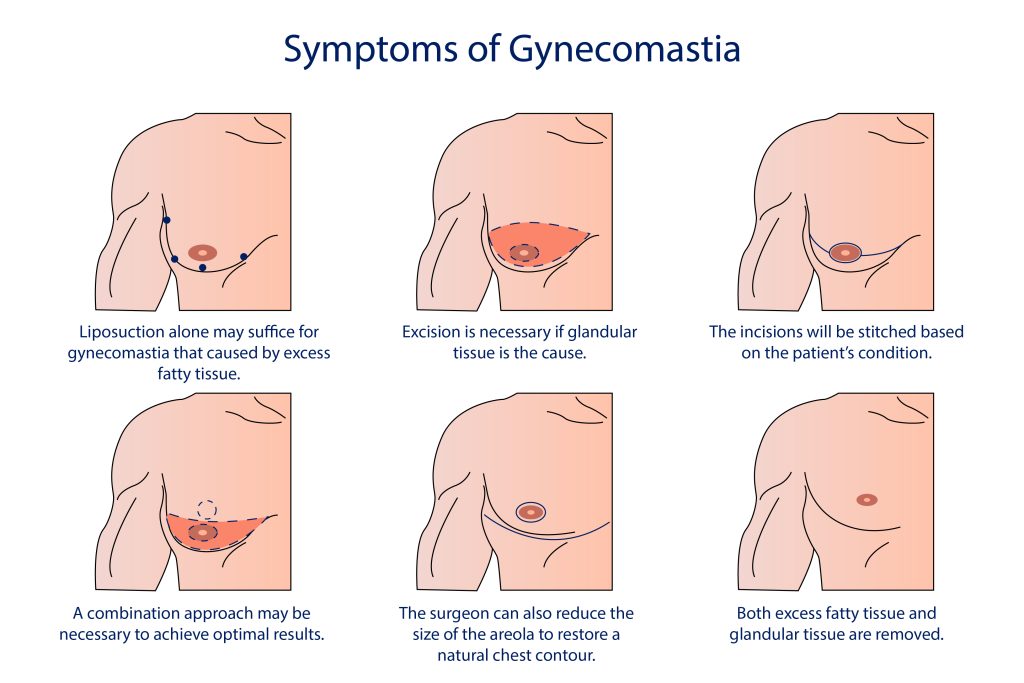Illustration showing gynecomastia surgery stages