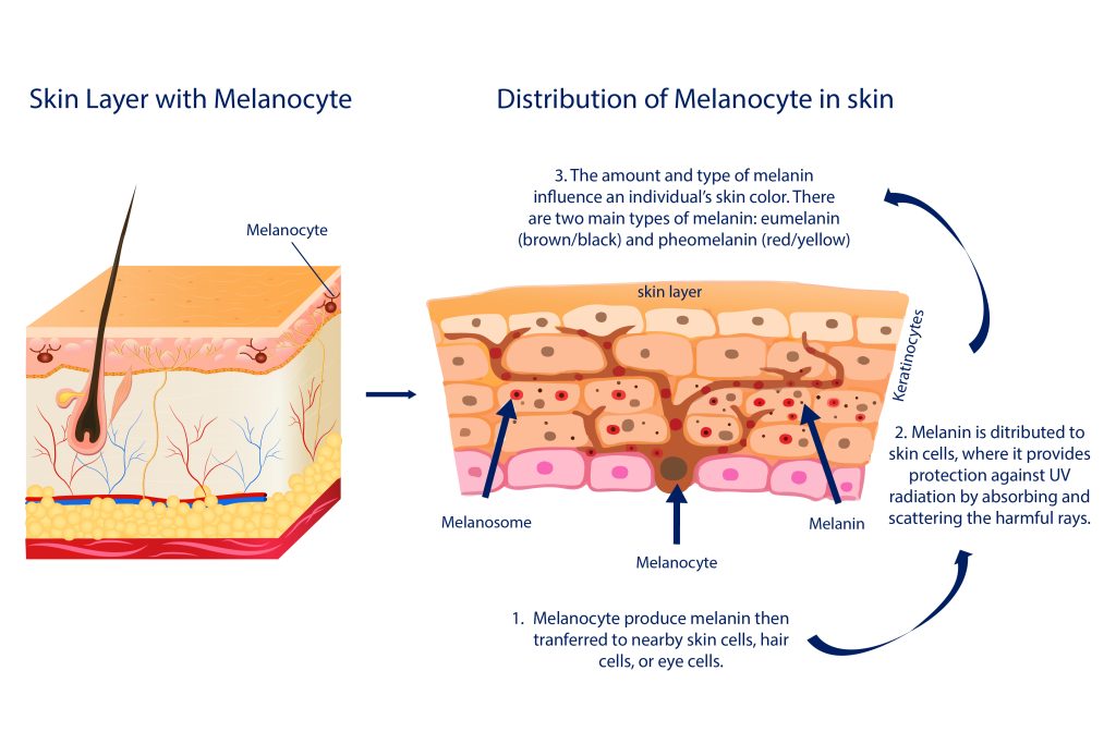 Labeled diagram of skin with Melasma