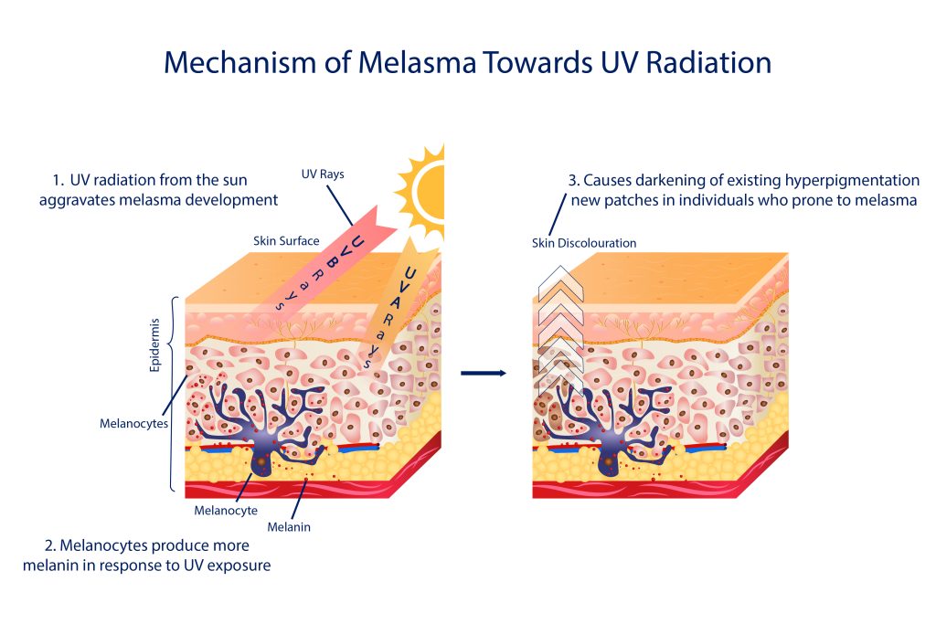 Labeled diagram of skin layer showing mechanism of Melasma condition