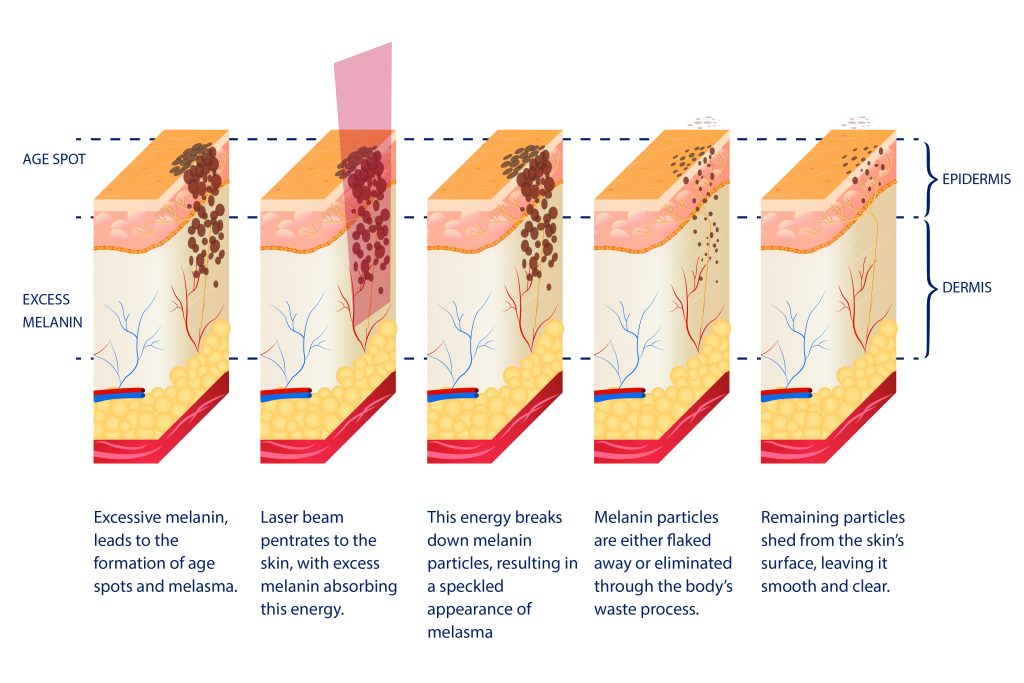 Labeled diagram explaining laser treatment for Melasma