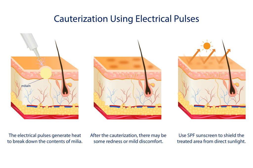 diagram explaining removal of milia seeds by cauterization using electrical pulses