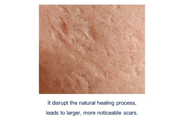 Acne scar