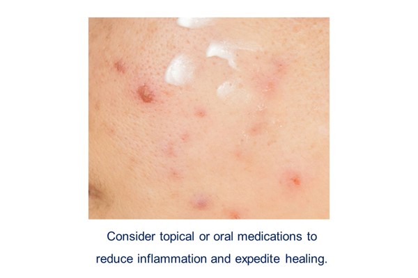 Topical medication for acne inflammation