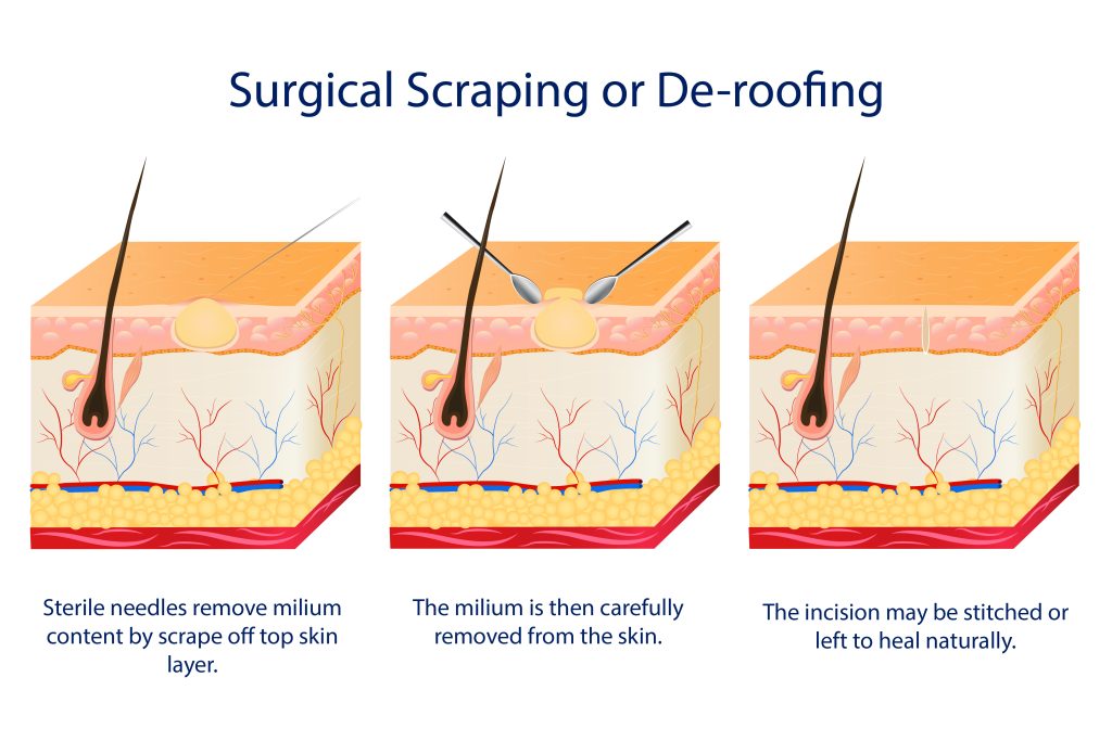 diagram explaining removal of milia seeds using surgical scraping or de-roofing