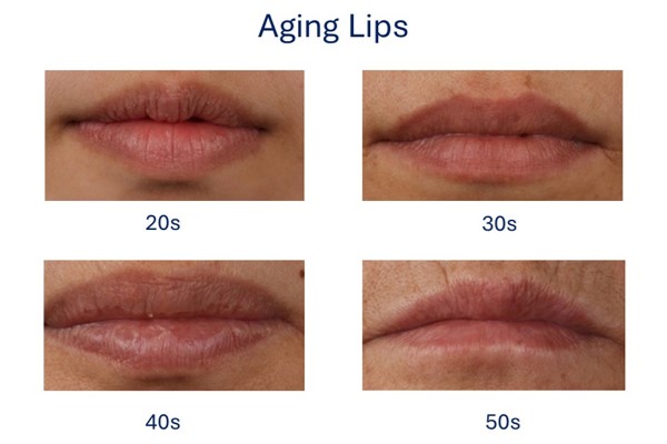 Aging Lips