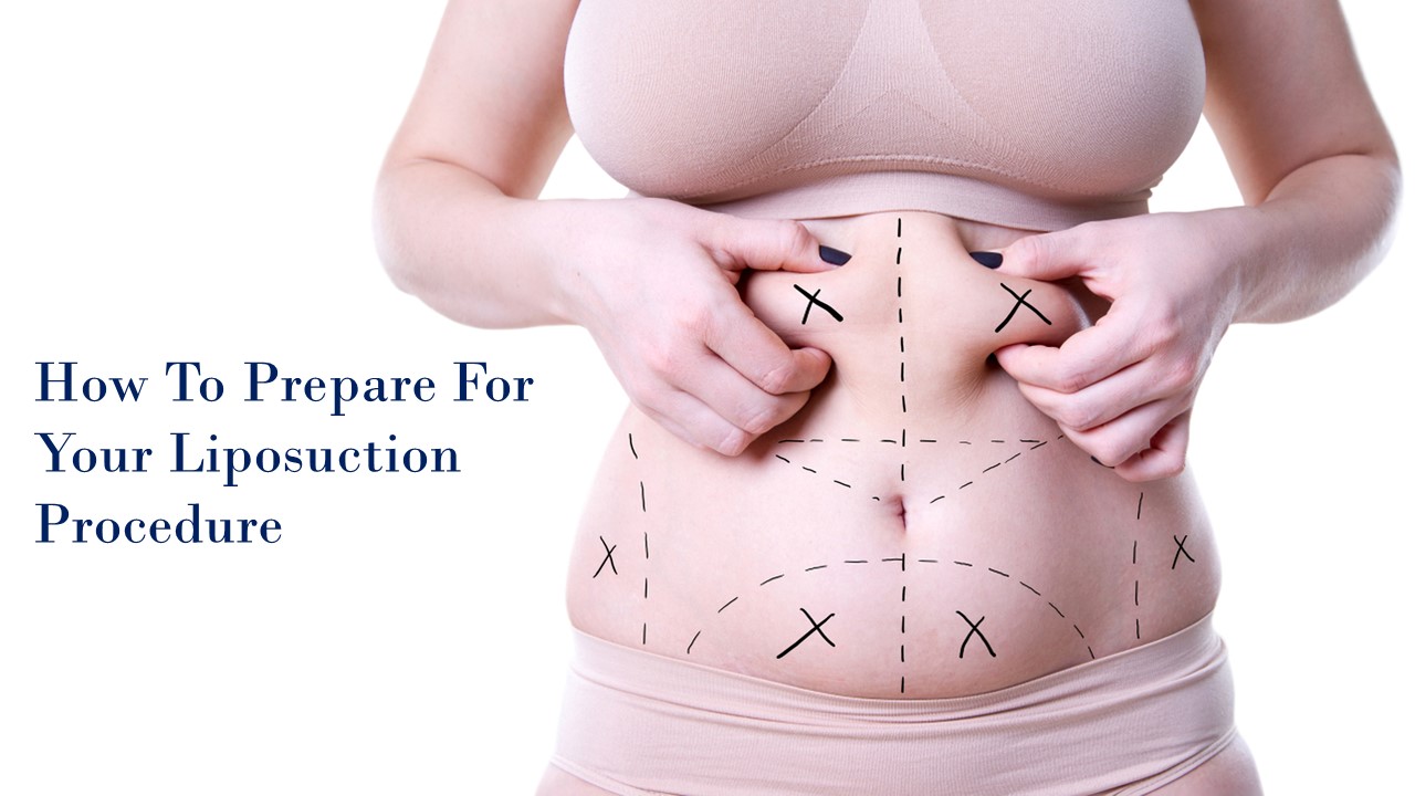 Banner image displaying the text 'How to Prepare for Your Liposuction Procedure' alongside a person measuring her belly.
