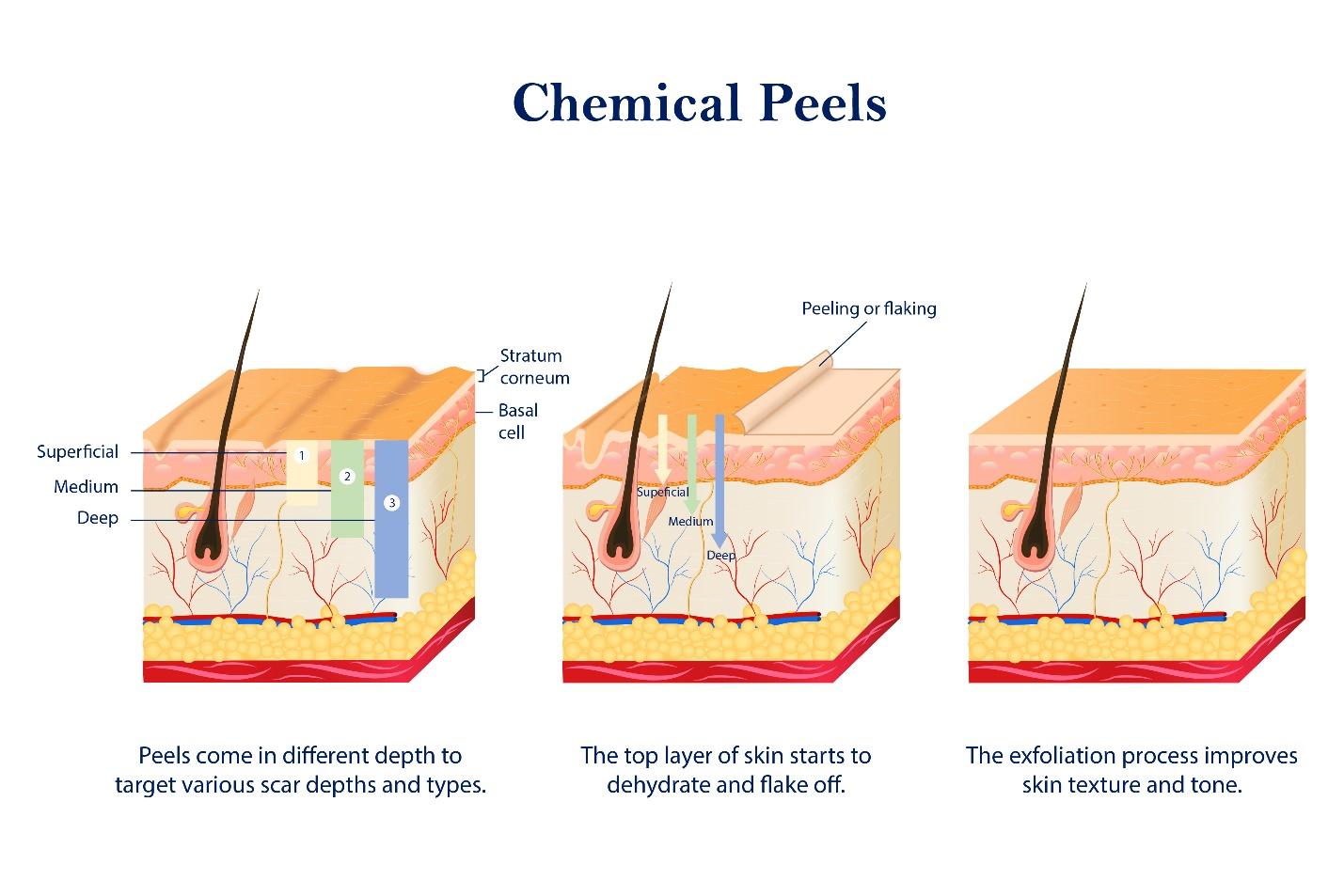 Procedures of chemical peels.