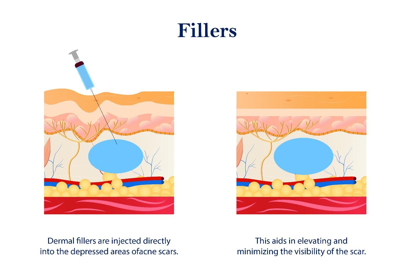 Procedures of fillers.