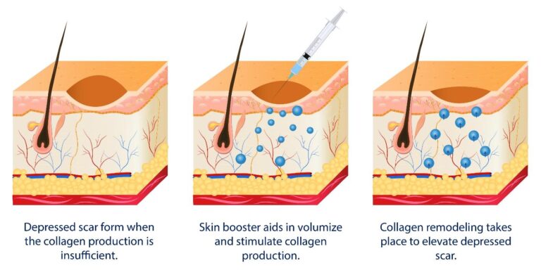 Benefits of Skinboosters and Injectables