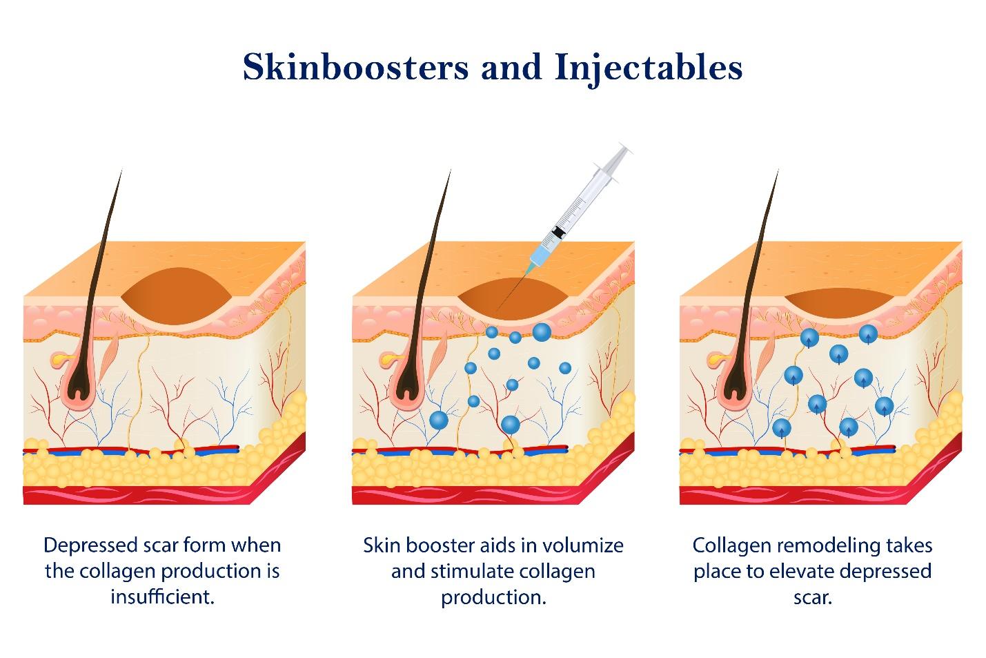 Procedures of skinboosters and injectables.