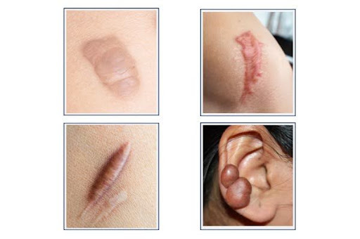 Different Types of Keloid Scar