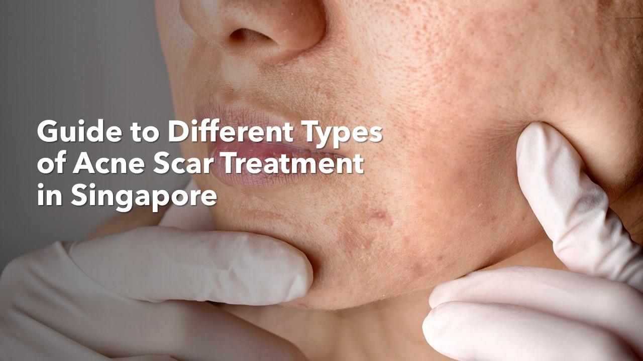 Guide to different types of acne star treatment in Singapore.