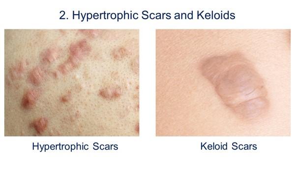 Images of hypertrophic scars and keloids.