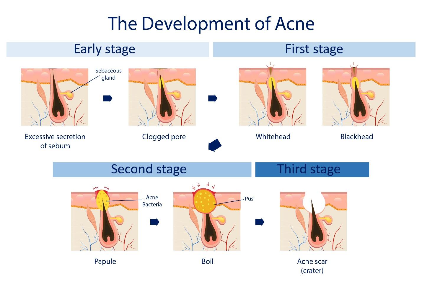 A visual representation of the evolution of acne, from initial breakouts to cystic acne, highlighting the skin's transformation.