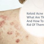 Keloid Acne Scar