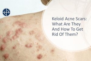 Keloid Acne Scar