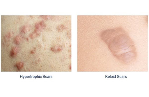 Keloid and Hypertrophic Scars
