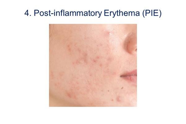 Image of post-inflammatory erythema (PIE).