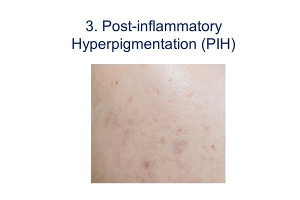 Image of post-inflammatory hyperpigmentation (PIH).