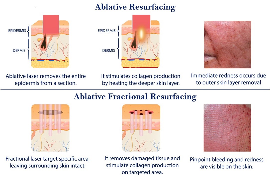 A diagram of skin resurfacing.