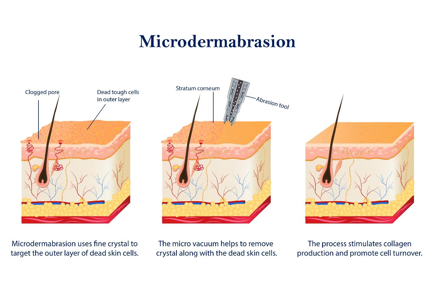 Procedures of microdermabrasion.