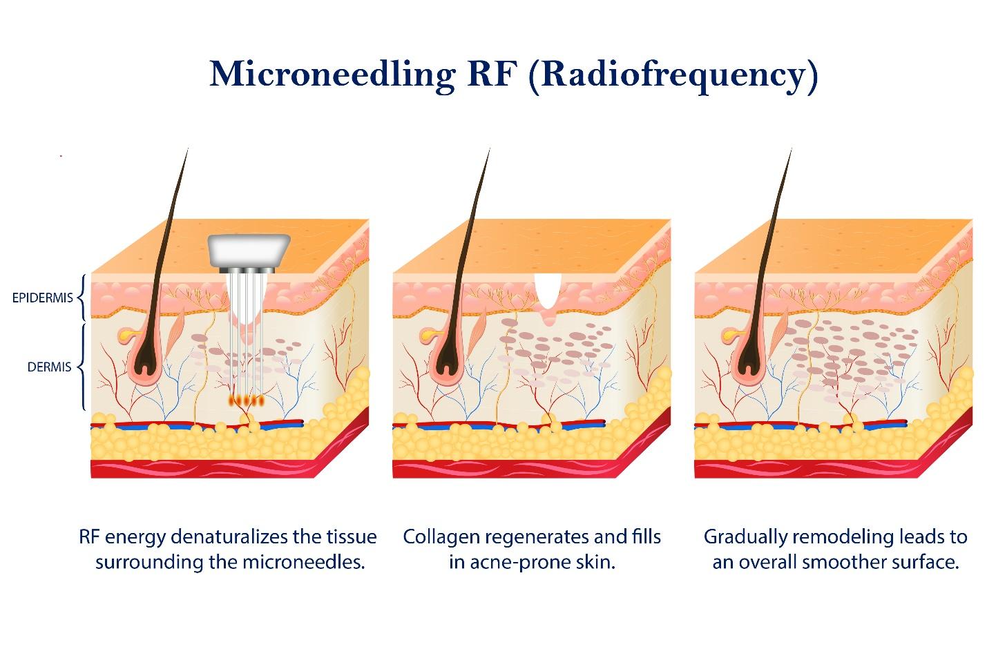 Procedures of Microneedling Radiofrequency.