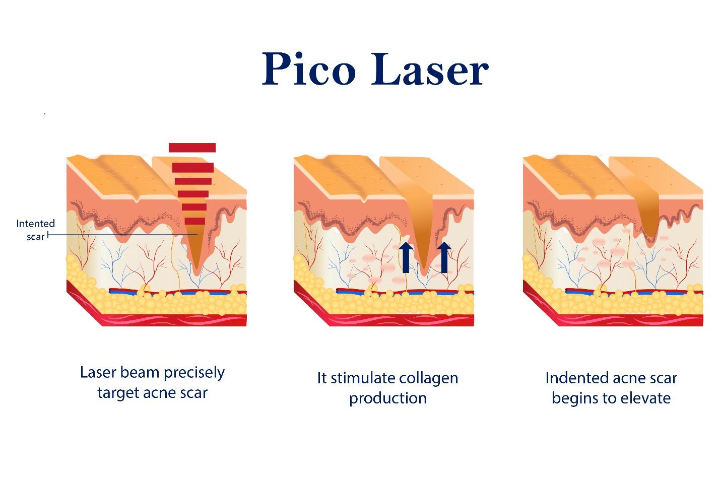 Procedures of Pico laser.