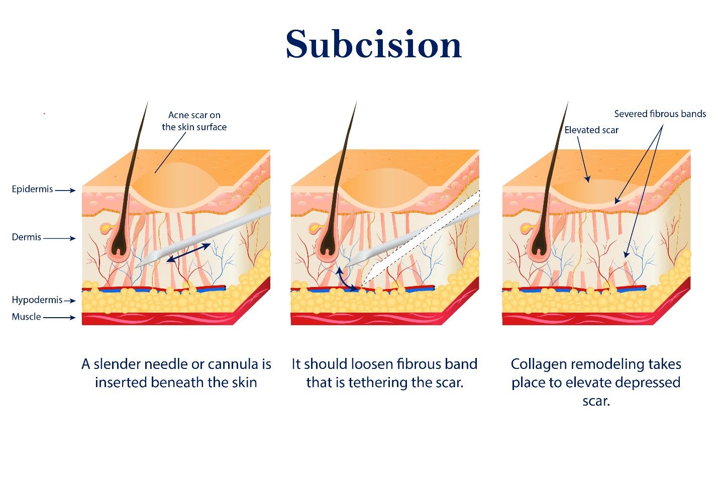 Procedures of subcision technique.