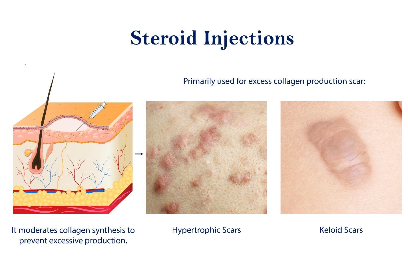 Steroid injection helps reduce scar size.