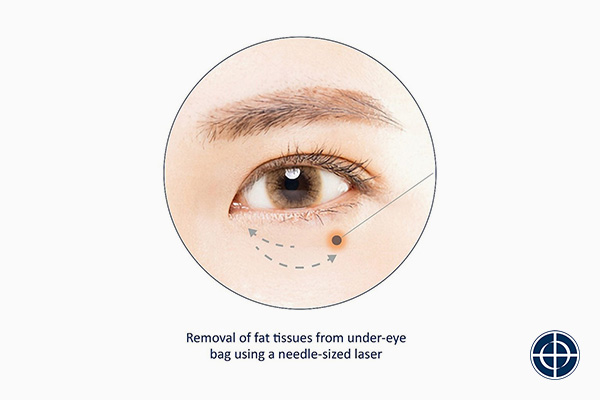 Scarless Eye Bag Removal Using Needle Sized Laser