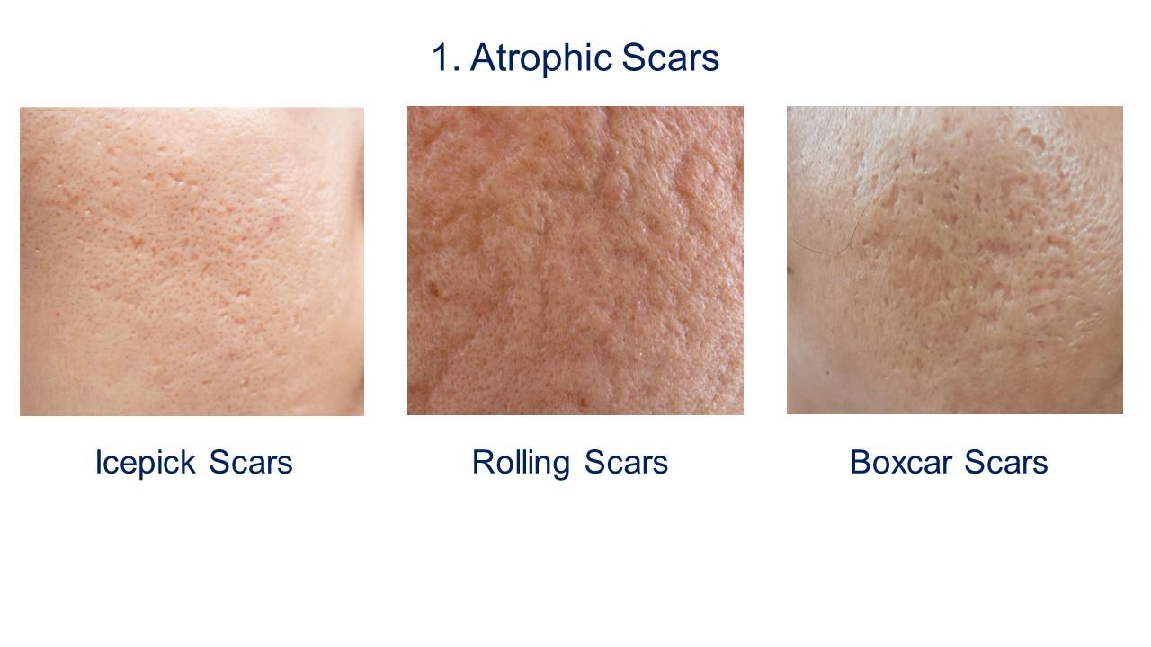 Types of atrophic scars.