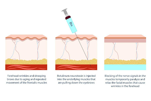 diagram explaining btx brow lift