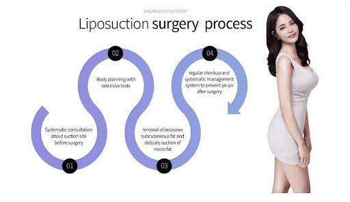 Liposuction surgery process.