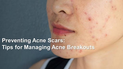 Preventing Acne Scars. Tips for Managing Acne Breakouts