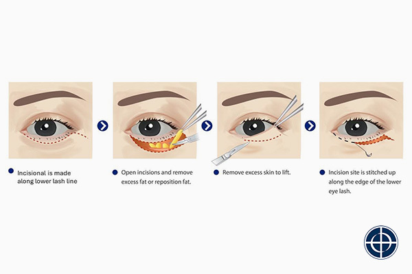 Incisional Eye Bag Removal Surgery